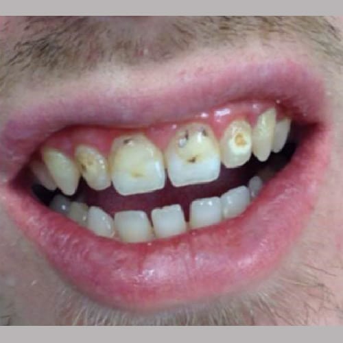 Before & After Gallery - Birmingham Family Dental Services